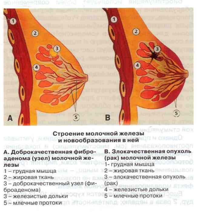 Опущение матки